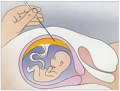 孕妇必须做羊膜穿刺吗？用于确诊胎儿是否有染色体异常！
